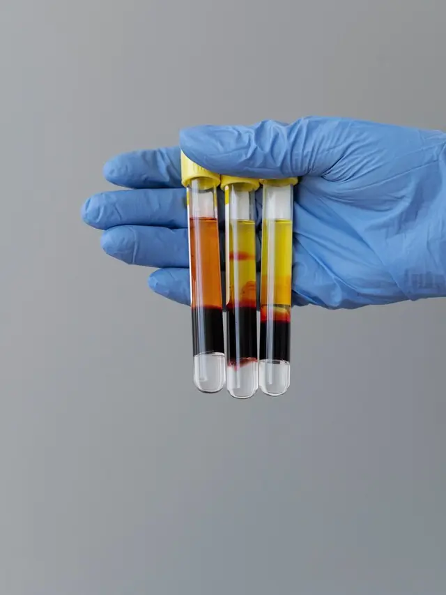 Ilustrasi urine keruh (Foto: freepik)