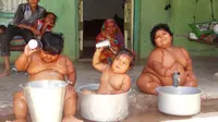 Tiga anak obesitas di India yang menjalani operasi khusus untuk menurunkan berat badan pada Juni tahun lalu kini lebih gemuk dari sebelumnya