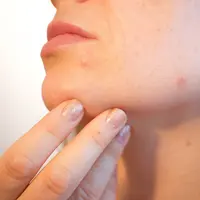 Ilustrasi jerawat. Sumber foto: pixabay.com/Kjerstin Michaela.