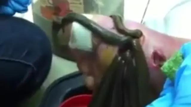 POPS : Pengobatan dengan Lintah