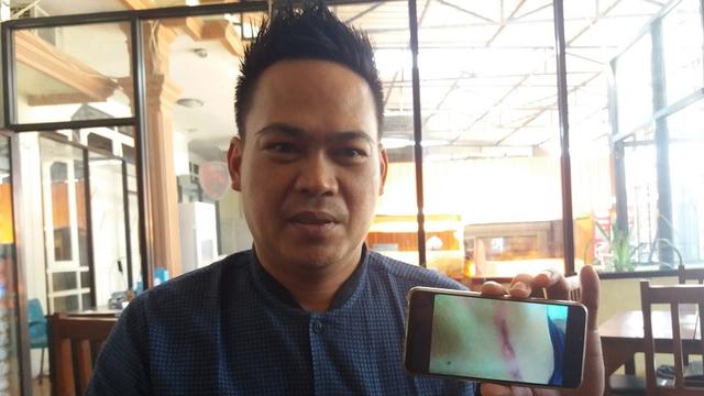Aktivis anti korupsi yang jadi korban pengeroyokan memperlihatkan bukti luka di bagian punggungnya usai dikeroyok (Liputan6.com/ Eka Hakim)