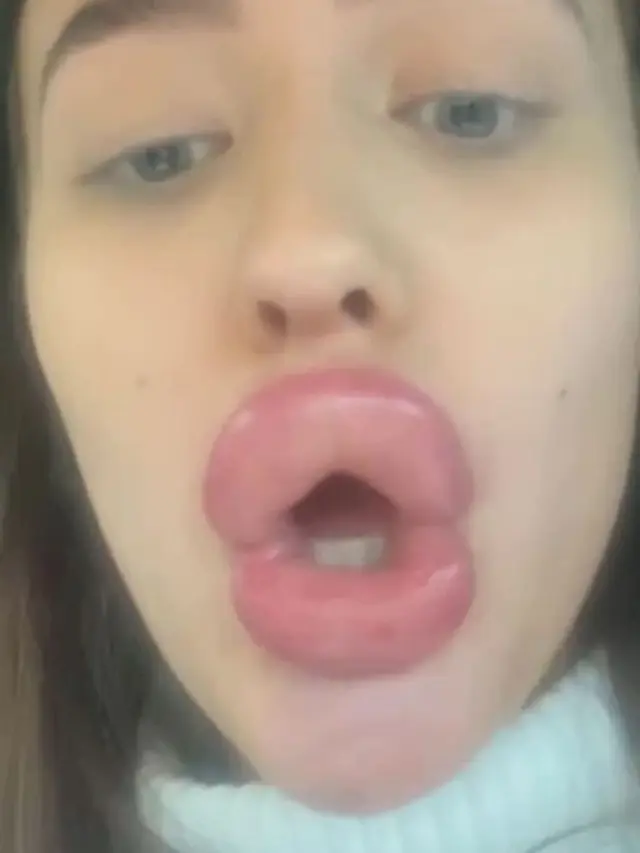 Lakukan Suntik Filler dengan Harga Murah, Bibir Wanita Ini Malah Bengkak Seperti Mau Meletus
