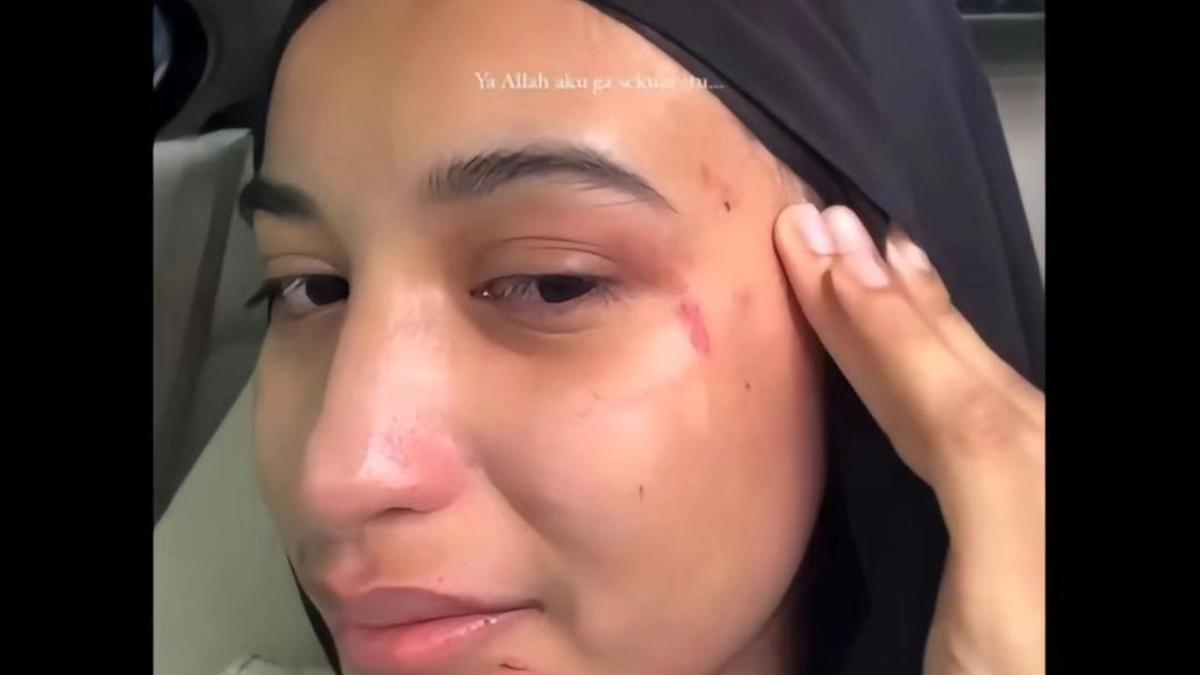 Cut Intan Nabila Perlihatkan Wajah Lebam dan Luka, Tulis Keterangan Menyayat Hati: Ya Rab Bantu Hamba Berita Viral Hari Ini Jumat 20 September 2024