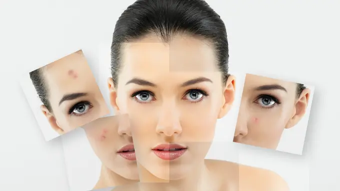 Mau Punya Kulit Sehat? Hindari 5 Makanan Ini