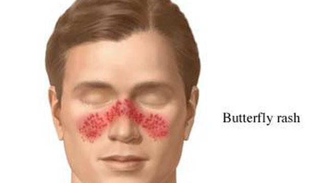 Lupus Serangan Kekebalan Tubuh Dengan Tanda Pipi Kupu Kupu Merah Health Liputan6 Com