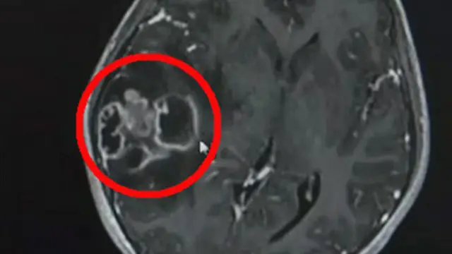 Pencet Komedo dengan Tangan Kotor, Bocah Ini Alami Infeksi Otak