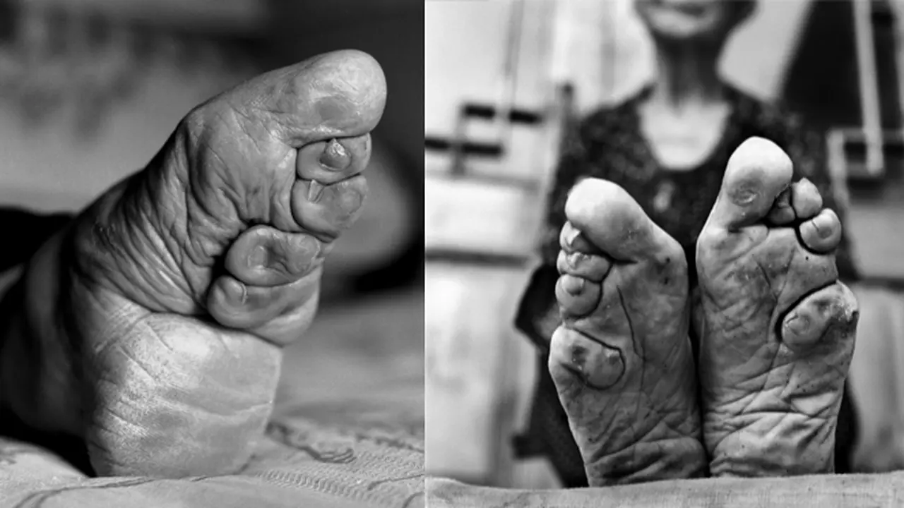 Tampil Cantik, Wanita di China Remukan Jari Kaki