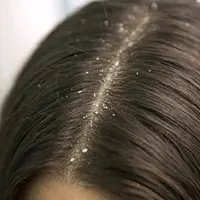 Ilustrasi ketombe. (iStockphoto)