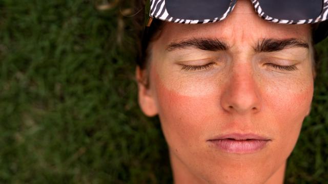 Ilustrasi sunburn, luka bakar akibat sinar matahari