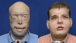 Perbedaan muka Patrick Hardison sebelum dan sesudah melakukan bedah plastik di Langone Medical Center NYU, New York, Amerika Serikat, (16/11/2015). Diperkirakan total biaya mencapat 1 juta dollar. (REUTERS)