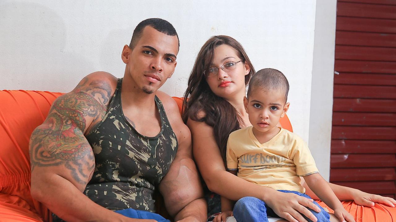 Mengerikan, Binaragawan Menyuntikkan Minyak dan Alkohol ke Tubuh