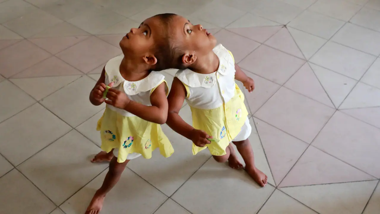 anak kembar siam
