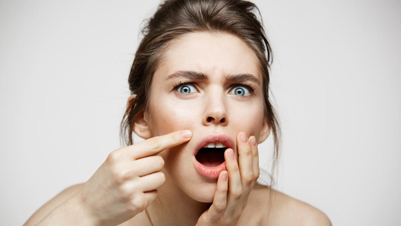 Ilustrasi bekas jerawat | Pixabay