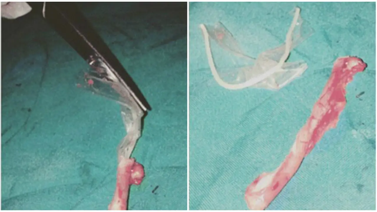 Mengeluh Sakit Bagian Perut, Ada Benda Asing di Usus Buntu