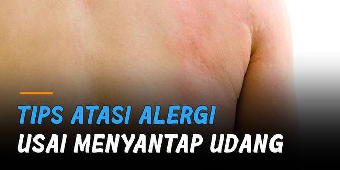 VIDEO: Tips Atasi Alergi Usai Menyantap Udang