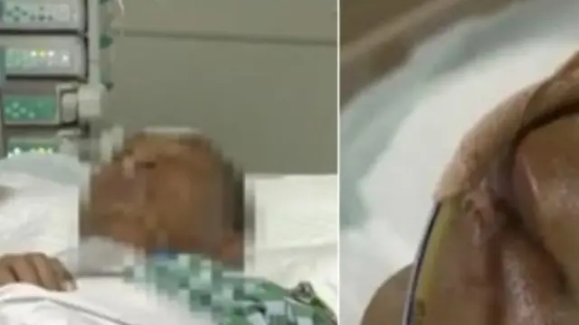 Pencet Jerawat di Dekat Bibir, Pria Ini Hampir Meninggal Dunia