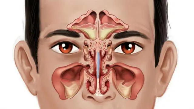 Sisa evolusi (3) sinus