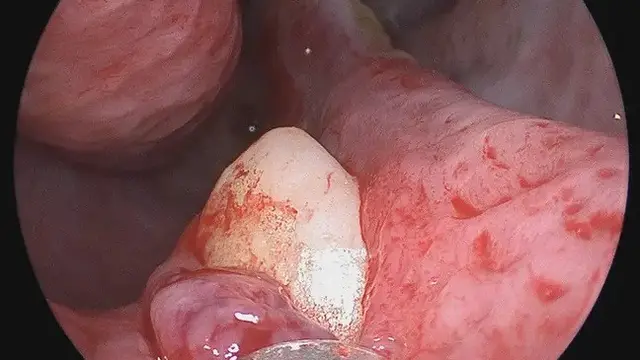 Gigi Tumbuh di Rongga Hidung