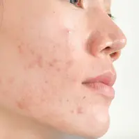 Ilustrasi Kulit Berjerawat Credit: pexels.com/Allisand