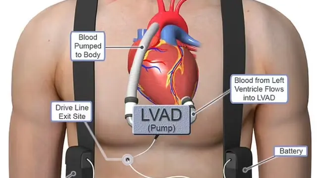 LVAD