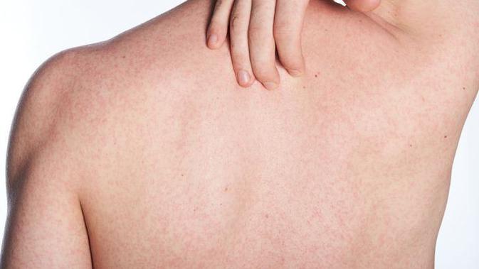 11 Cara Menghilangkan Panu Dengan Bahan Alami Ketahui Penyebab Dan Gejalanya Hot Liputan6 Com