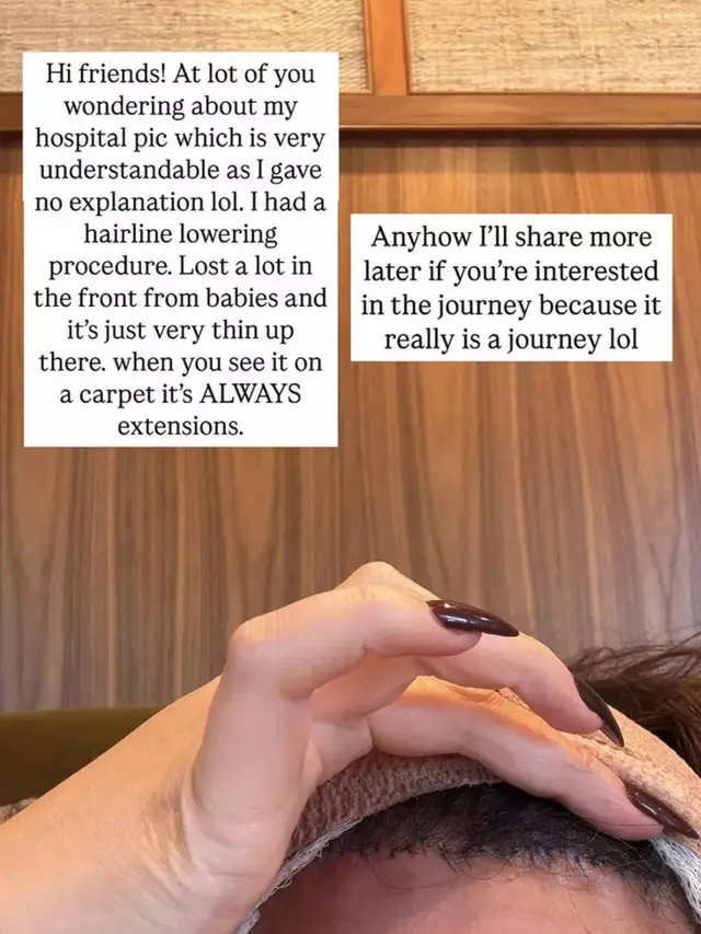 Chrissy Teigen Jalani Operasi Hairline Lowering Akibat Rambut Rontok Pasca Melahirkan. [@chrissyteigen]