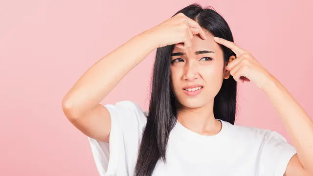 Habis Jerawat Timbul Noda Hitam, Apa Penyebabnya dan Gimana Cara Mengatasinya Ya?