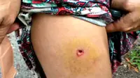 Empat Hari, Wanita Ini Tidak Sadar Terkena Peluru Nyasar