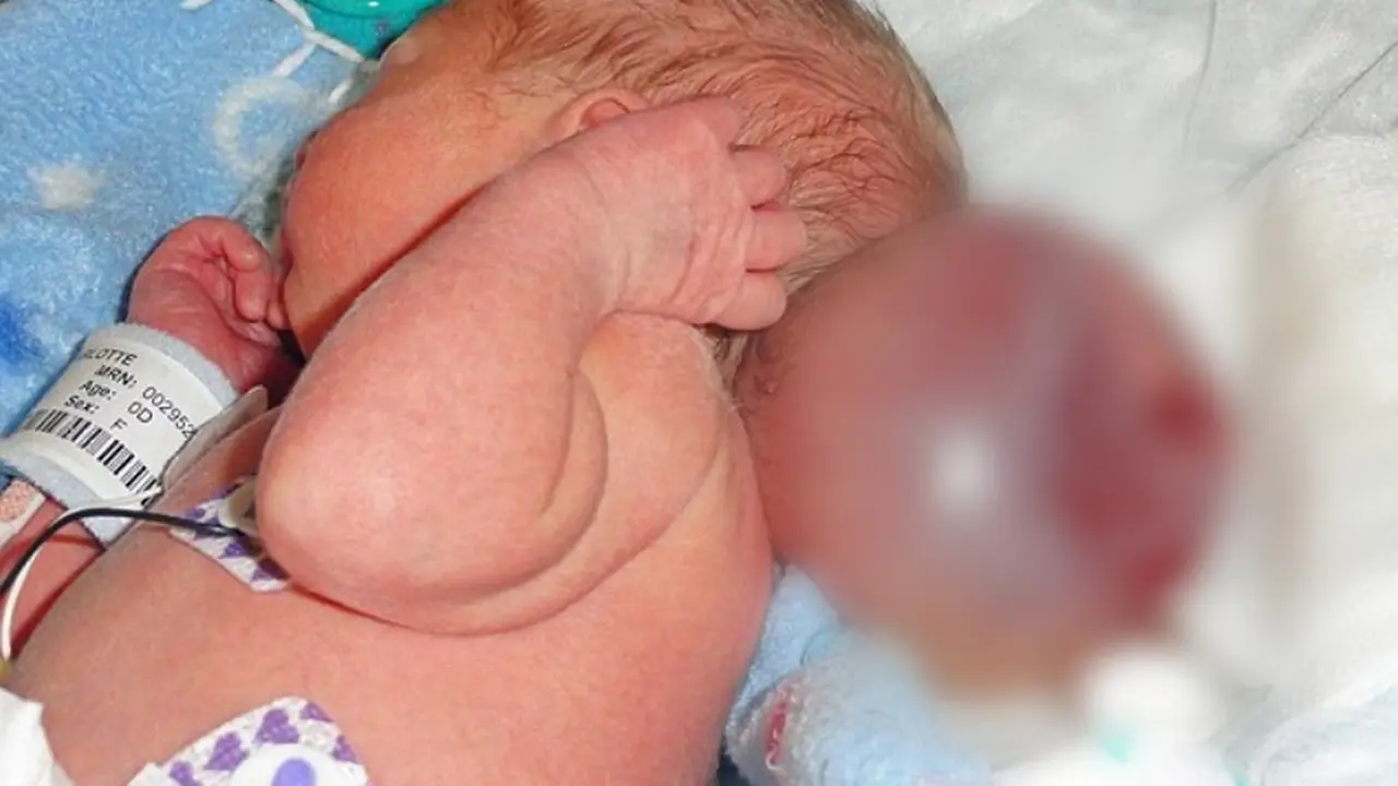 Kisah Perjuangan Bayi dengan Otak di Luar Tengkorak 