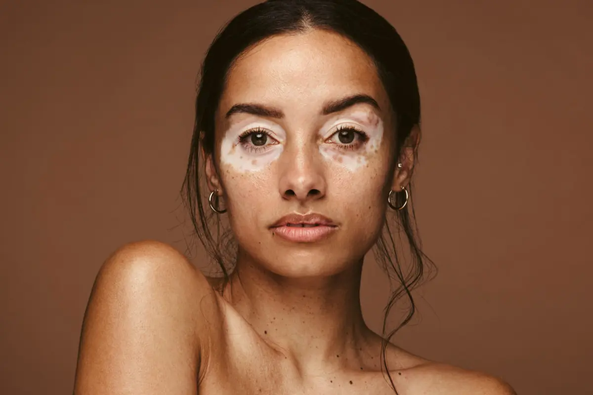 kulit vitiligo