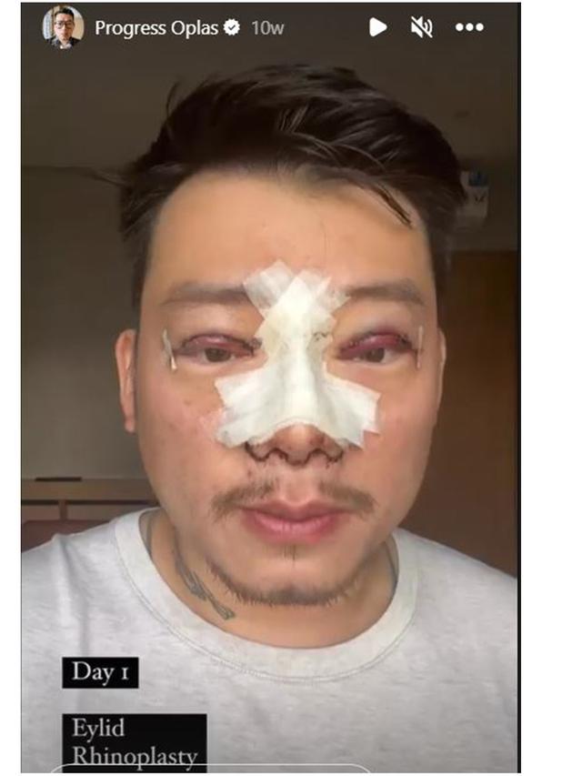 7 Potret Chef William Gozali Jalani Operasi Plastik, Perubahannya Bikin Pangling