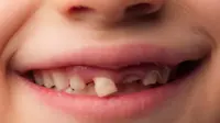 Ilustrasi gigi anak. Foto: berriendental