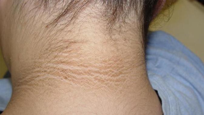 Kulit Leher Hitam Jadi Kinclong Dengan Bahan Ajaib Ini Health Liputan6 Com