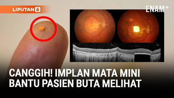 Implan Mata Mini Bantu Pasien Buta Bisa Melihat Lagi