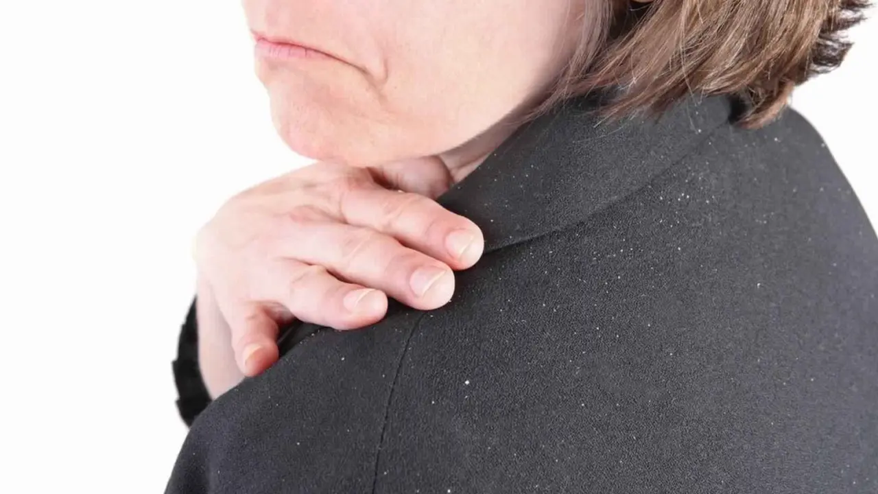 5 Cara Mengatasi Ketombe dengan Bahan Alami