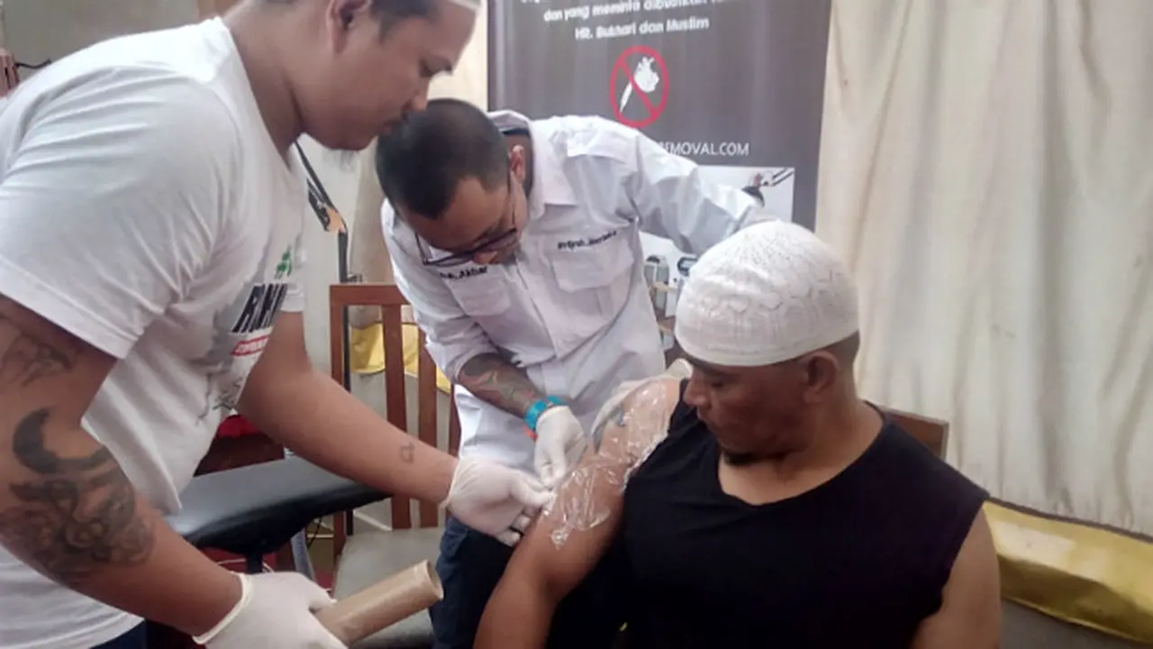 Menghapus Tato Gratis di Garut