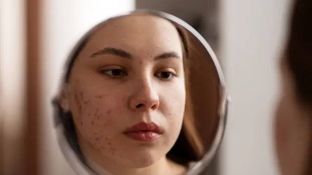 Seorang perempuan sedang bercermin melihat jerawat yang ada di wajahnya (Foto Dok: Freepik/freepik)