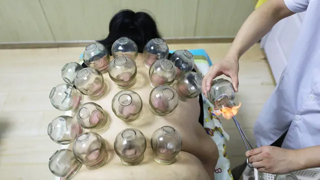Melihat Terapi Bekam Penurun Berat Badan di China