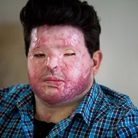 Korban 'serangan' cairan asam takut disangkakan sebagai monster oleh sang anak.