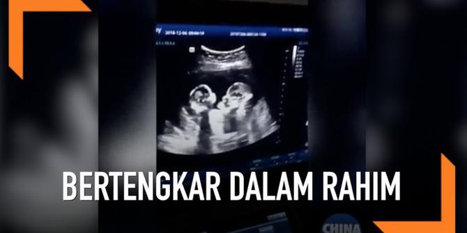 VIDEO: Bayi Kembar Bertengkar dalam Rahim Saat di USG