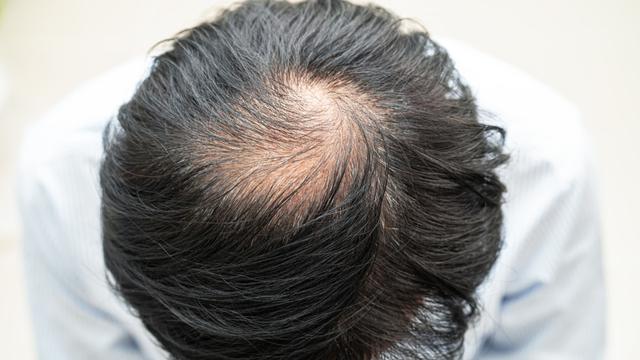 Rambut Menipis pada Pria, Apa Sih Penyebabnya? Waspadai Risiko Kebotakan, Temukan Solusinya!