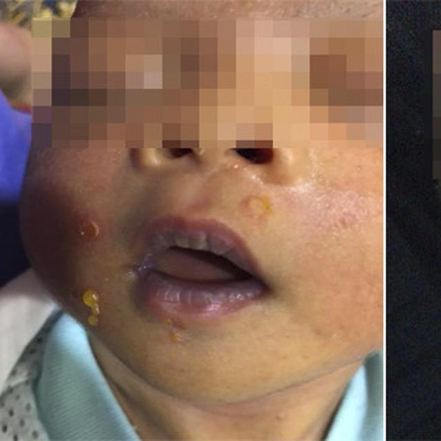 Gara Gara Dicium Kerabat Orangtua Wajah Dan Tubuh Bayi Ini Melepuh Citizen6 Liputan6 Com