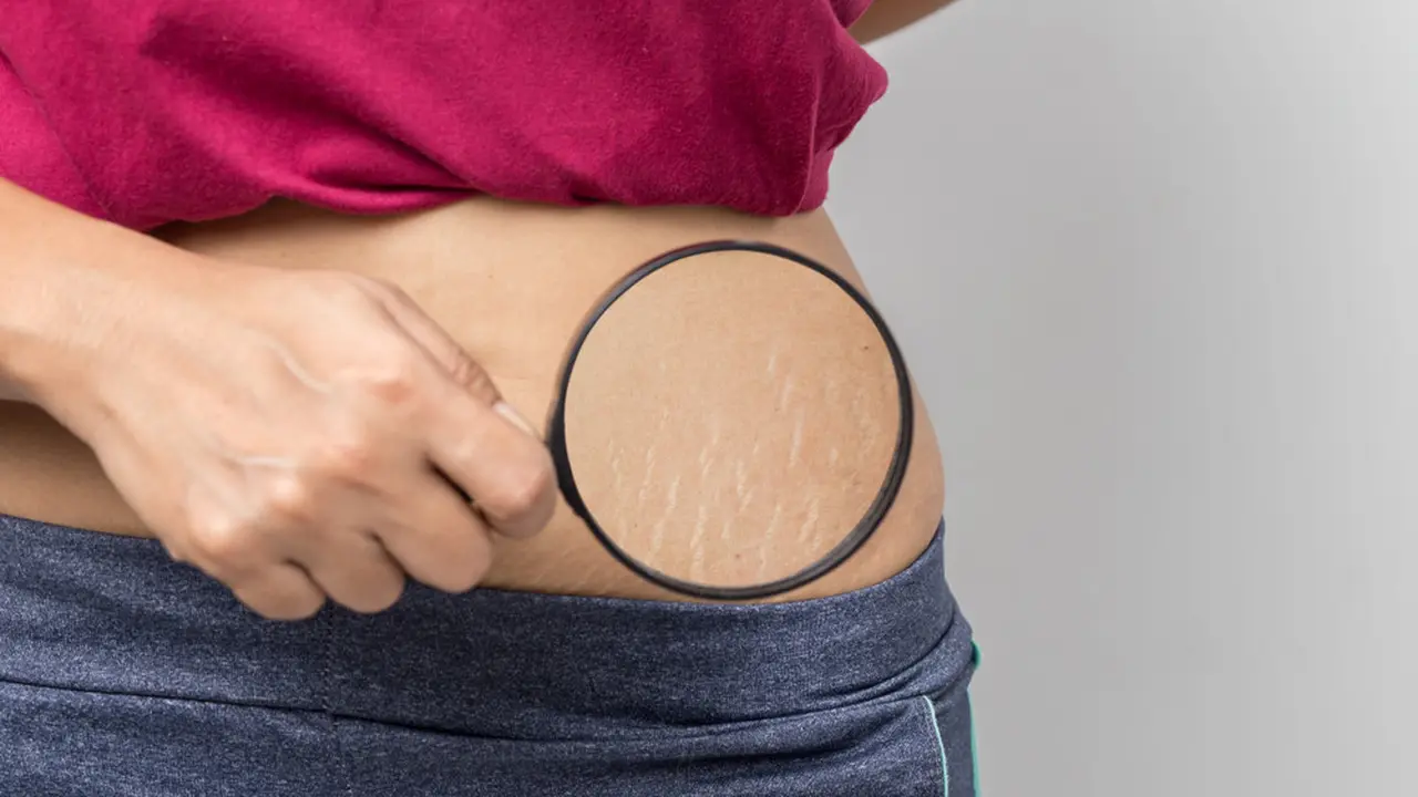 Cara Menghilangkan Stretch Mark Pada Kulit yang Mengganggu, Bisa Dilakukan di Rumah