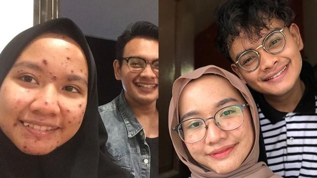 Tetap Setia Dengan Pacar Yang Berjerawat Parah Pria Ini Tulis Pesan Menyentuh Hot Liputan6 Com