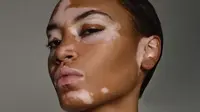 Akibat vitiligo, Amy Deanna memiliki warna kulit berbeda dari orang kebanyakan, tapi itu pulalah yang membuat ia sukses jadi seorang model. (Foto: Instagram/@amy.deanna)