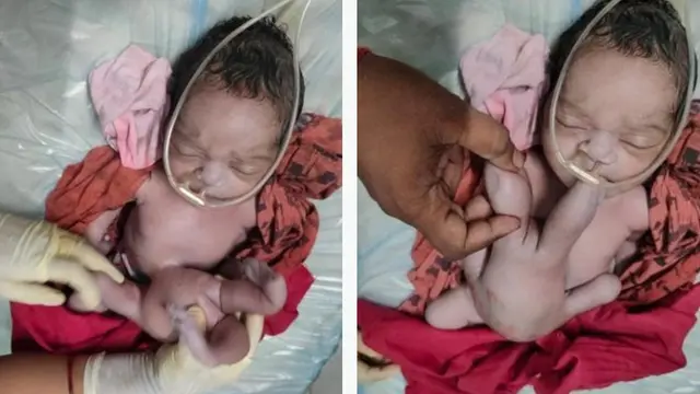 Bayi di India Lahir dengan Empat Kaki dan Empat Tangan, Dianggap Reinkarnasi Tuhan