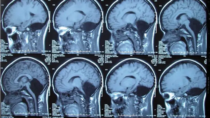 MRI pasien yang kehilangan otak kecil