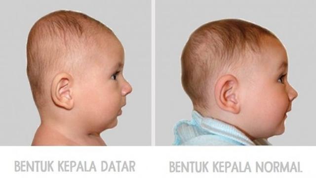 Tumbuh Kembang Bayi Bisa Dilihat dari Bentuk  Kepalanya 