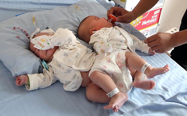 Bayi kembar siam yang dipisahkan dengan melakukan operasi bedah | Photo: Copyright telegraph.co.uk
