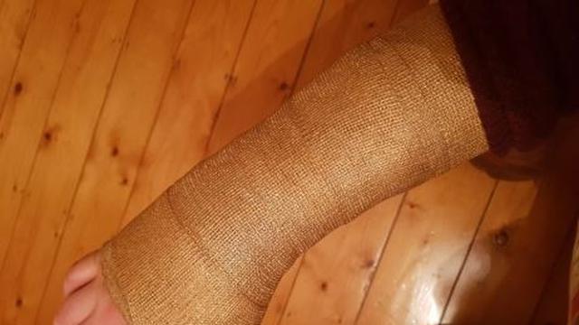 Pergelangan Tangannya Cedera, Pria Ini Gunakan Hiasan Gips yang Unik